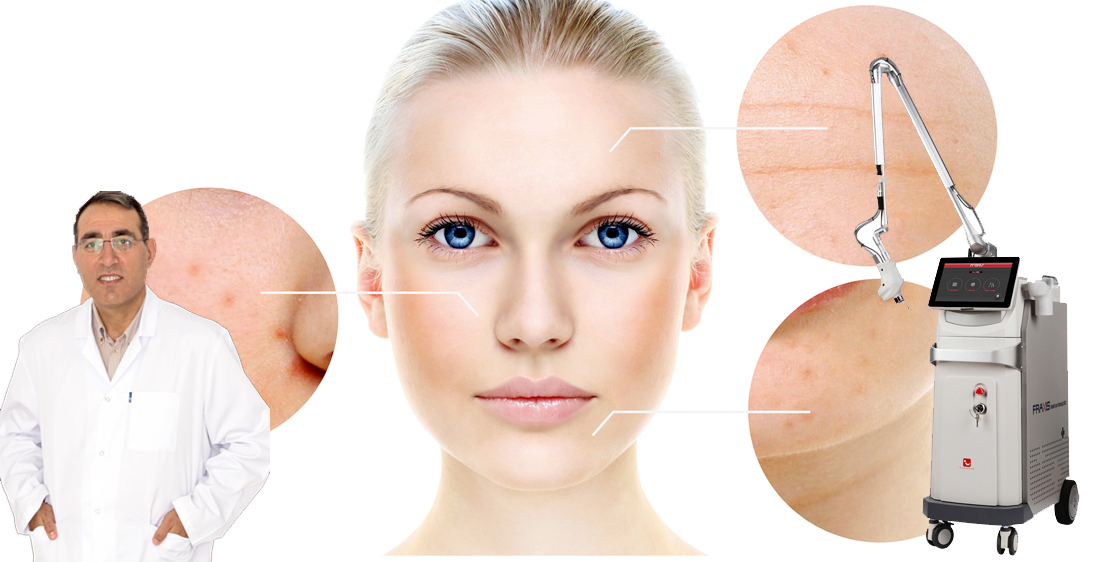 Fraksiyonel Karbondioksit Lazer Özel Hastane’de