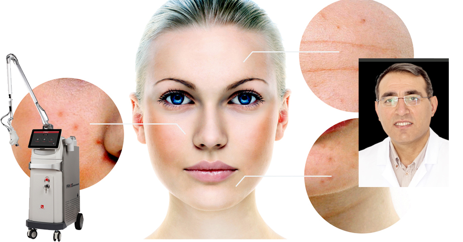 Fraksiyonel Karbondioksit Lazer Özel Hastane’de